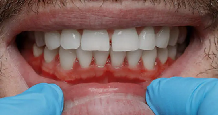 gum disease