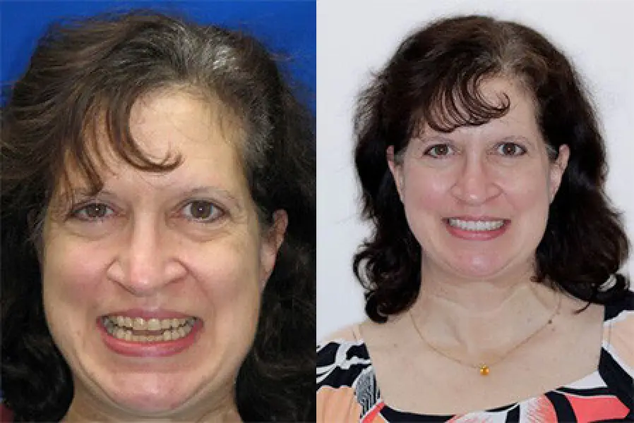 patient michelle before & after