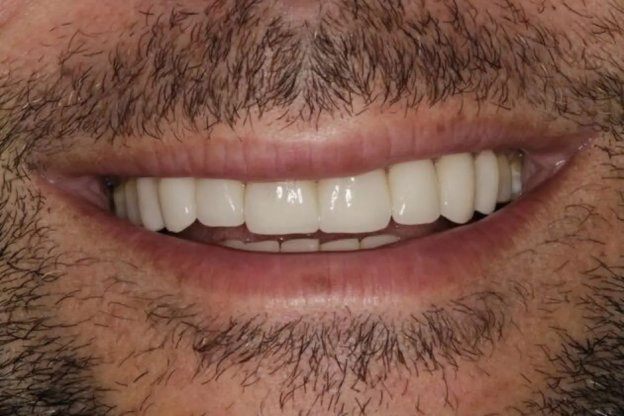 mike after smile maveover close up smike