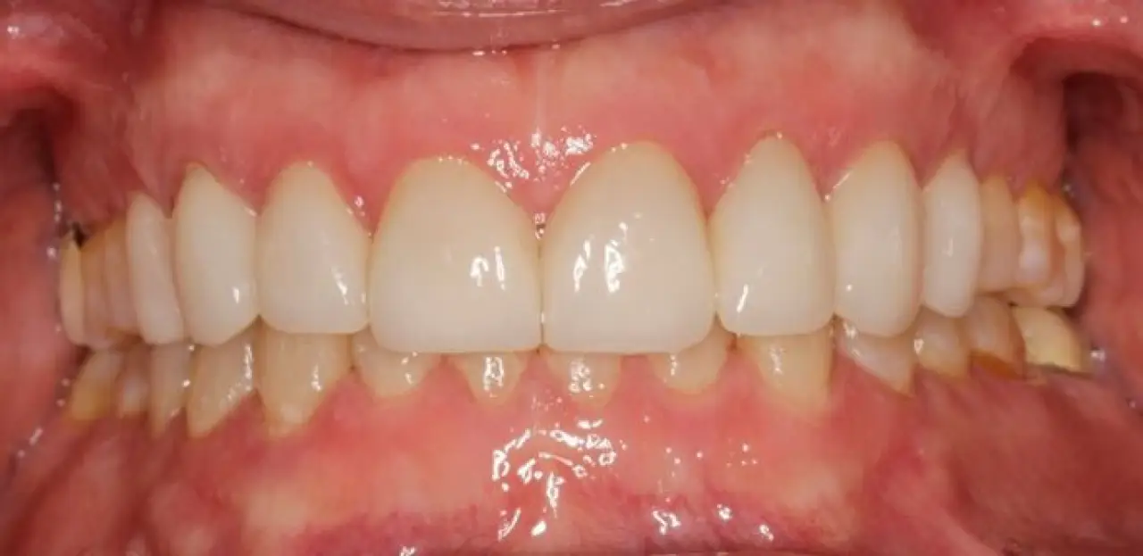 smile makeover mike extreme close up