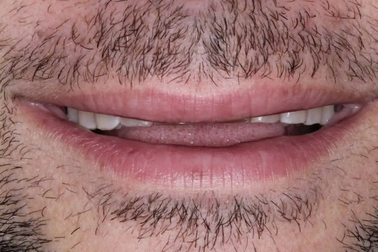smile before smile makeover, close up