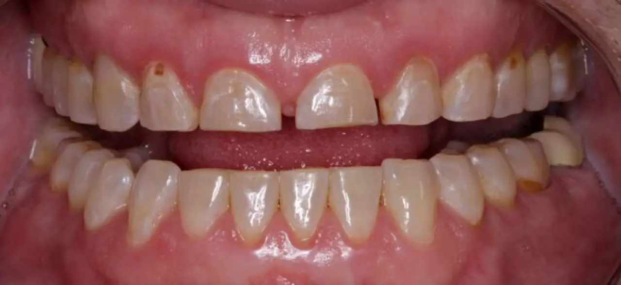 smile makeover mike extreme close up before