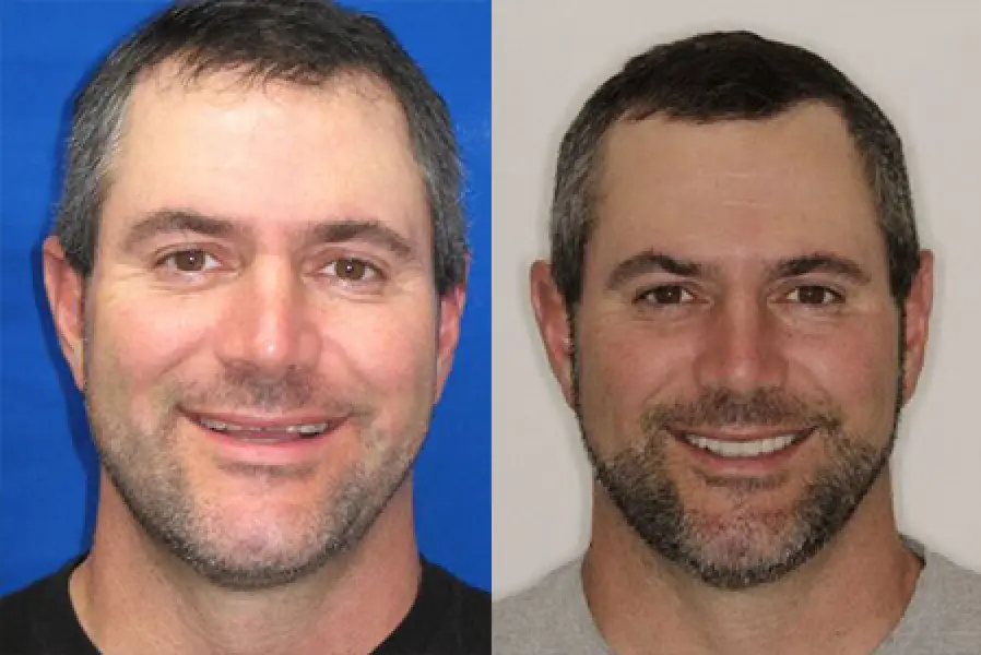 patient mike before & after