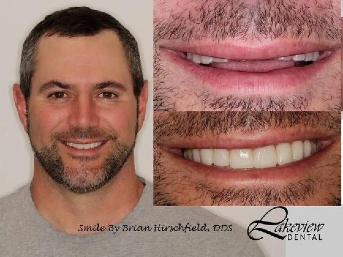 gallery view of mike's smile makeover