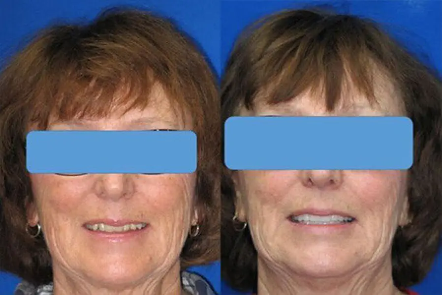 patient molly before & after