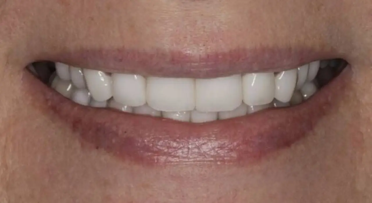 susan smile makeover after photo close up