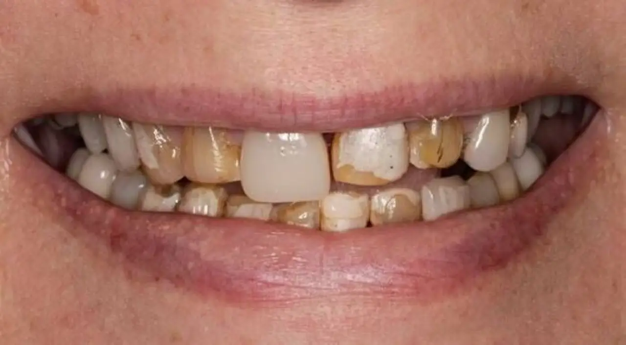 susan smile makeover before photo close up