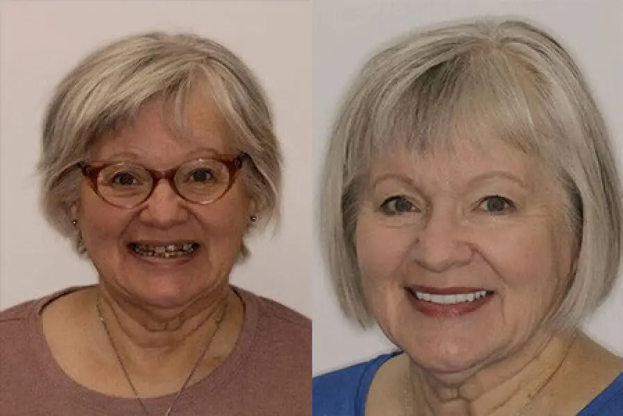 patient susan before & after