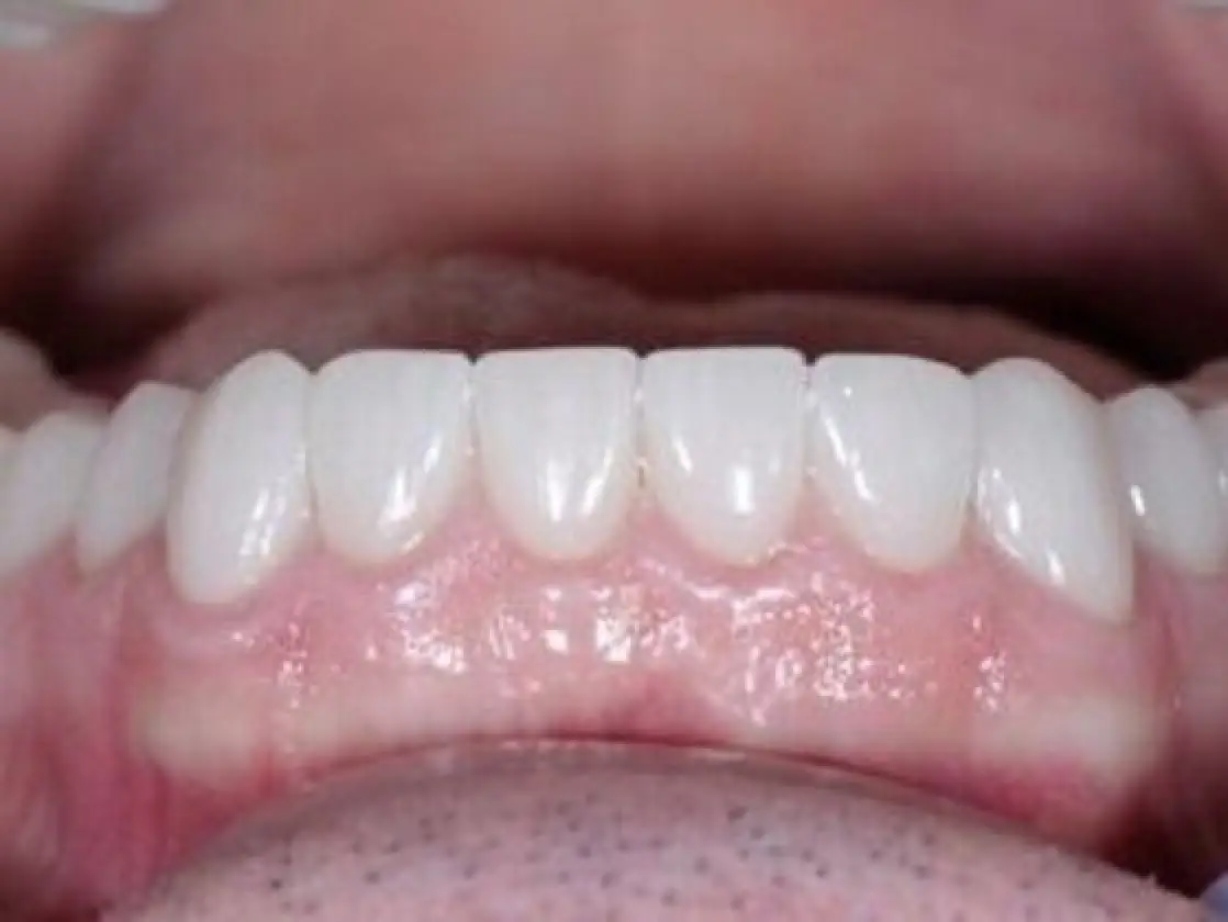 worn lower teeth after 2