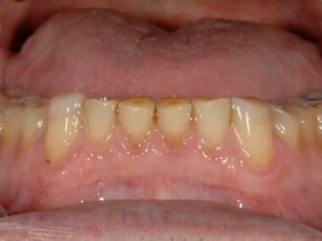 worn lower teeth before 2