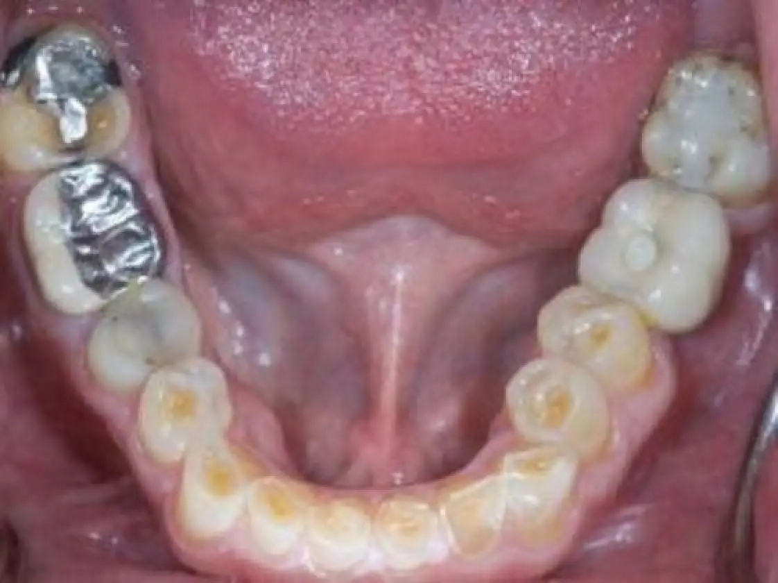 worn lower teeth before