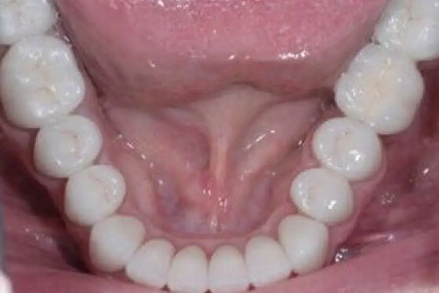 worn lower teeth