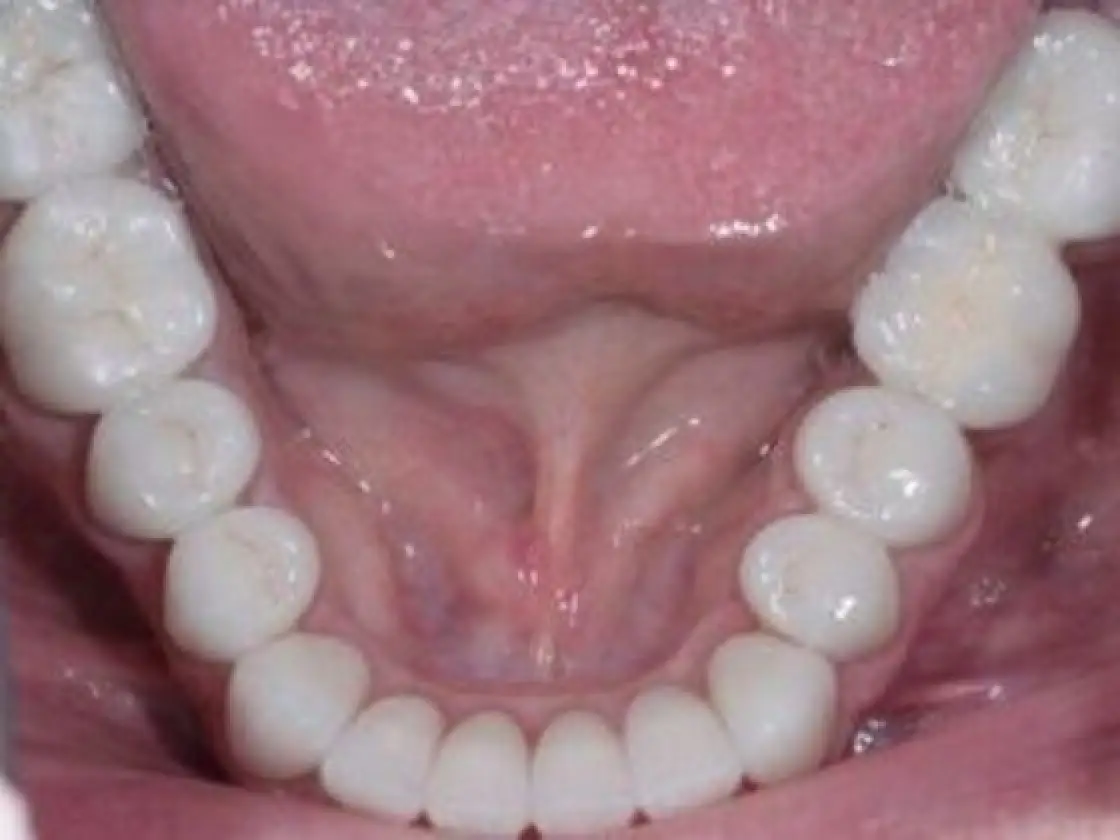 worn lower teeth after