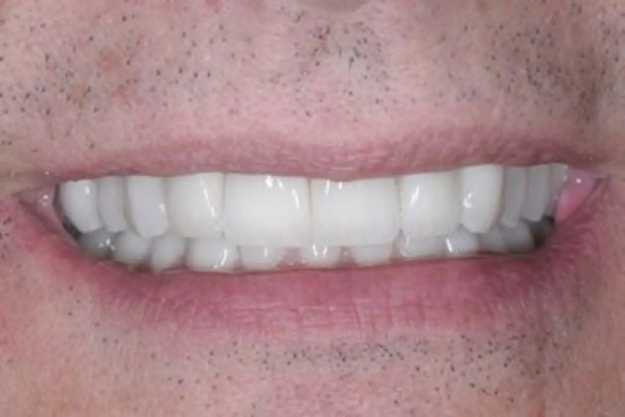 another case of worn upper teeth after treatment