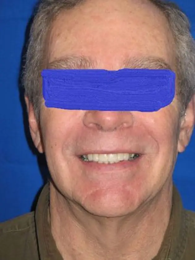 worn upper teeth after treatment