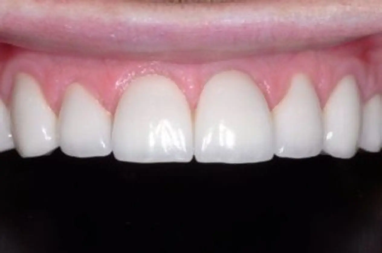 worn upper teeth after treatment