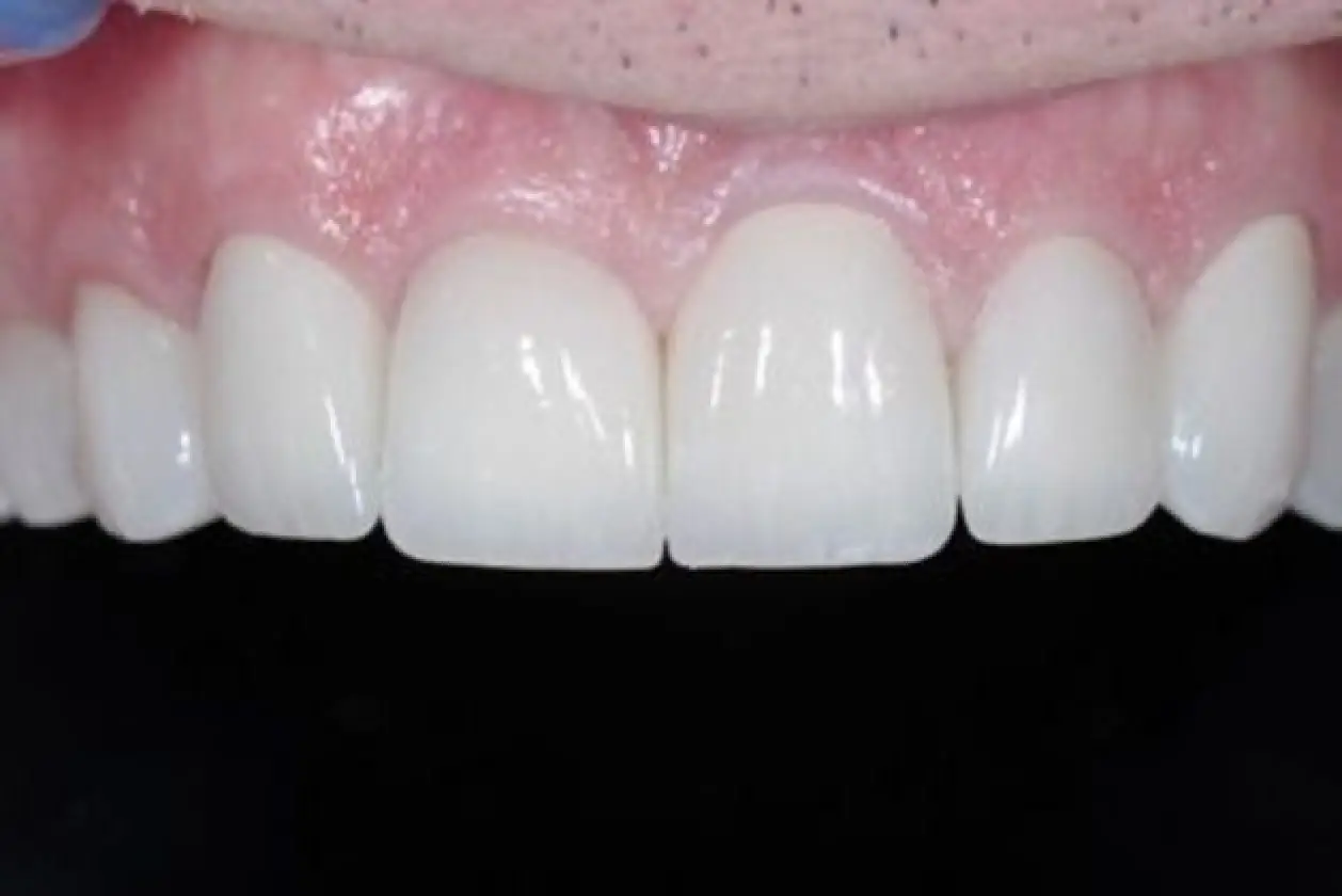 worn upper teeth after treatment