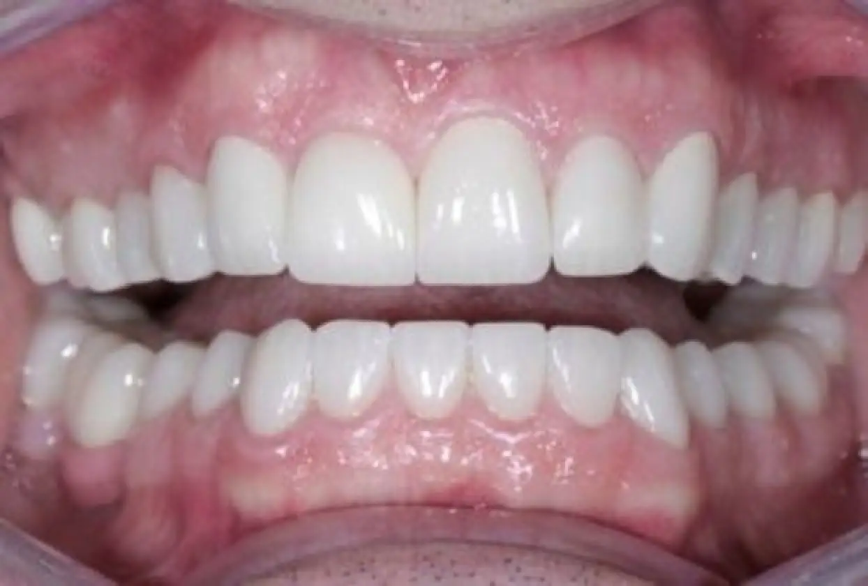 worn upper teeth after treatment