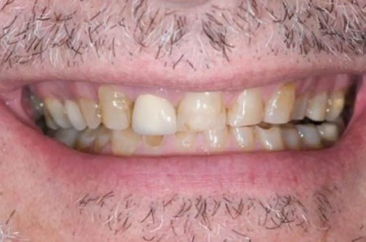 another case of worn upper teeth before treatment