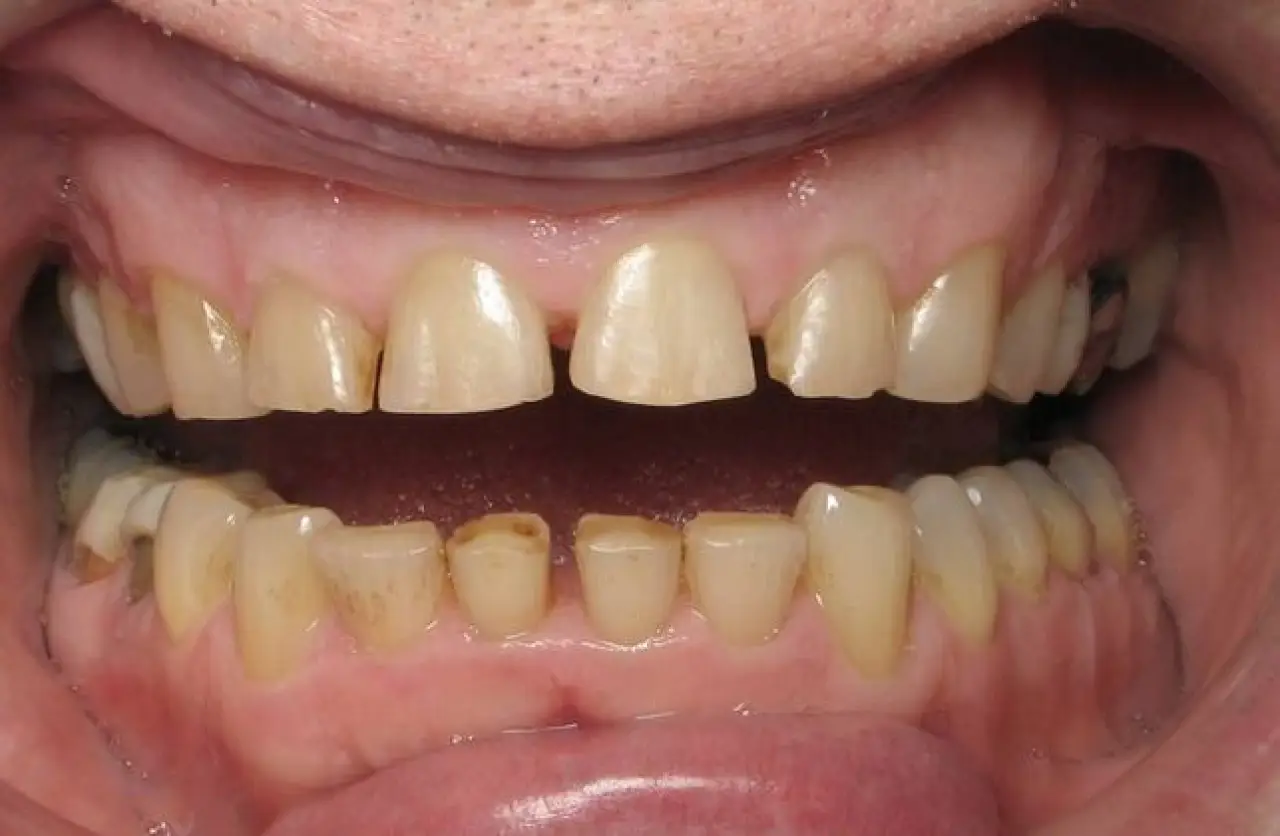 worn upper teeth before treatment