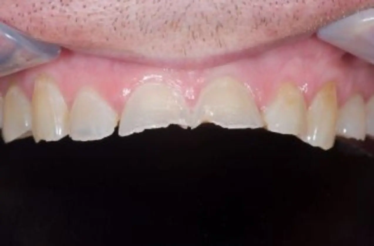 worn upper teeth before treatment