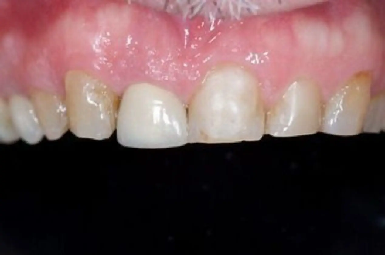 worn upper teeth before treatment