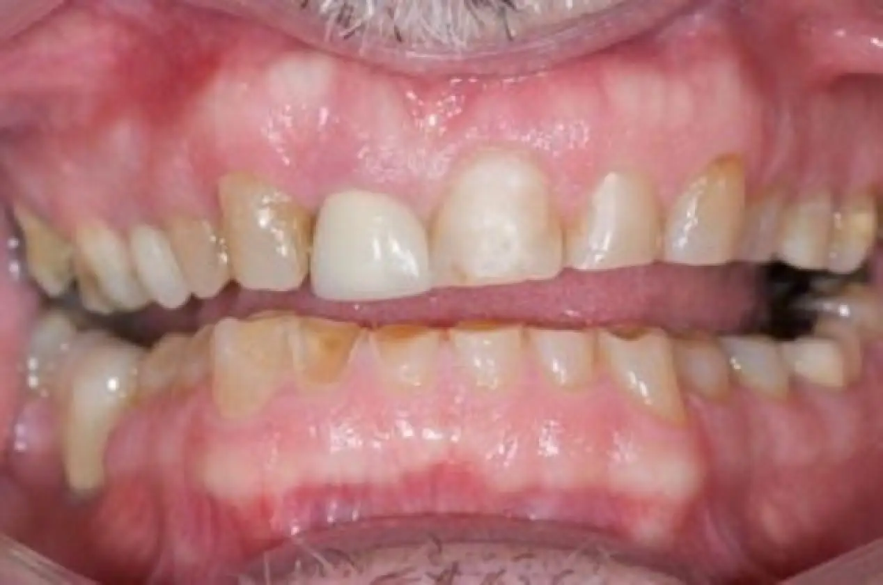worn upper teeth before treatment