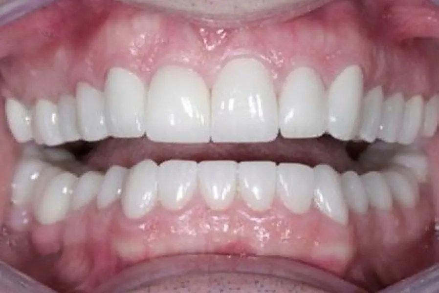 worn upper and lower teeth