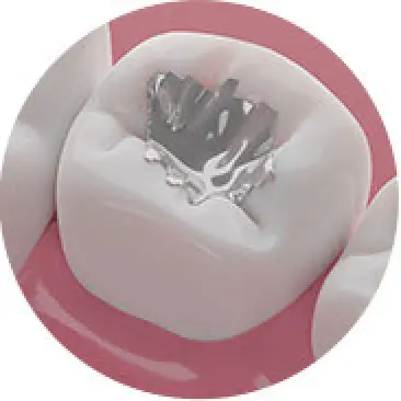 Dental Amalgams