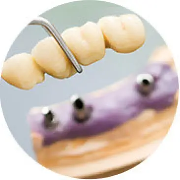 Dental Bridges