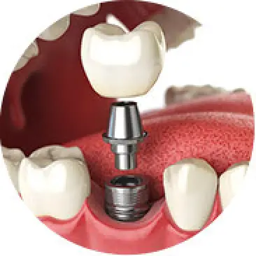 Dental Crowns