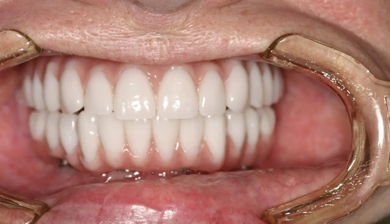 Dental Implants