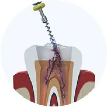 Non-surgical Root Canals