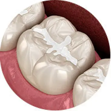 Dental Sealants