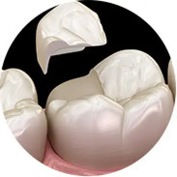 Tooth Fillings & Restorations