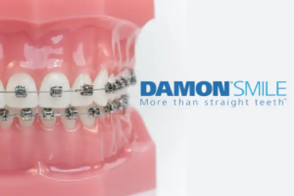 Damon Smile braces efficiently straighten teeth for comfort and a wider, natural-looking smile.