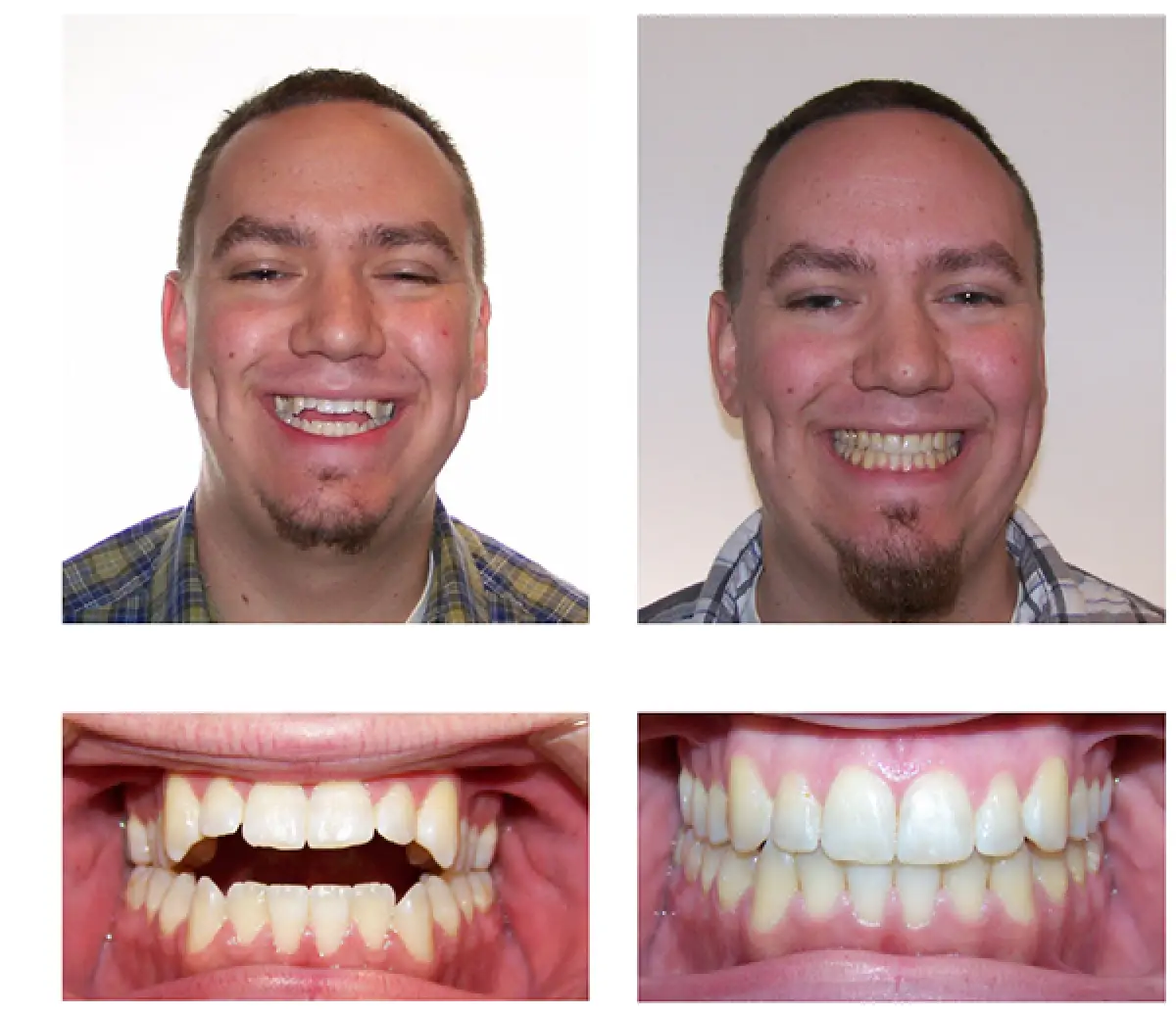 Man smiling in before-and-after photos; lower images show dental improvement after treatment.