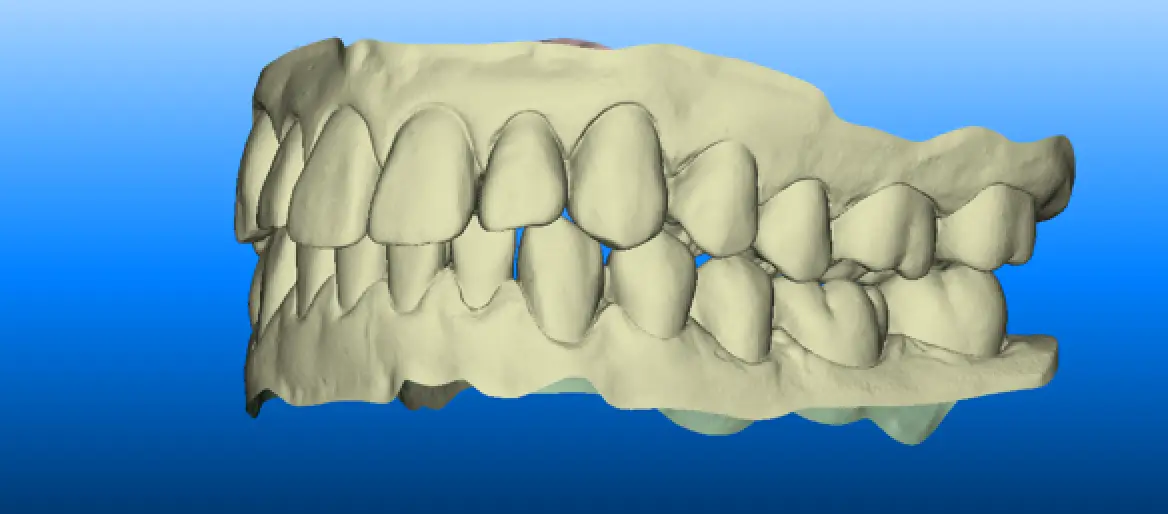 3D digital model of human teeth showing both upper and lower jaws against a blue gradient background.